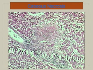 Caseous Necrosis
 