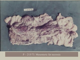 P – 215/73. Mesenteric fat necrosis
 