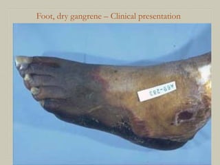 Foot, dry gangrene – Clinical presentation
 