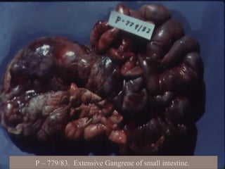 P – 779/83. Extensive Gangrene of small intestine.
 