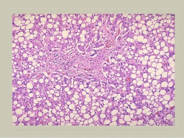 Necrosis & gangrene pathology calcification
