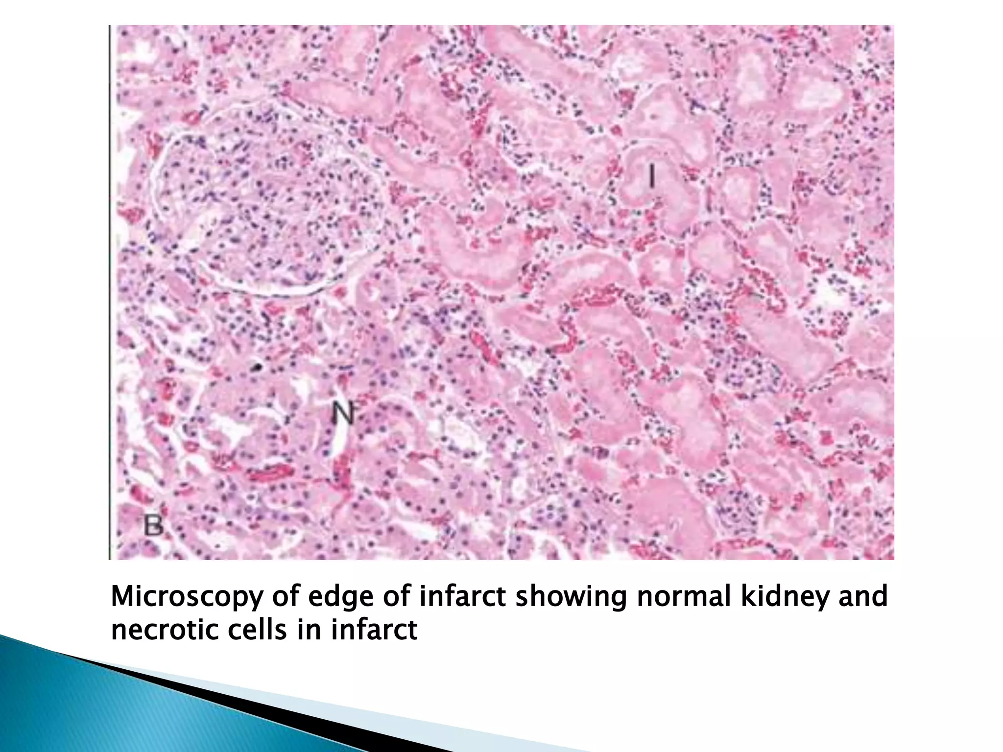Necrosis,gangrene and apoptosis | PPTX
