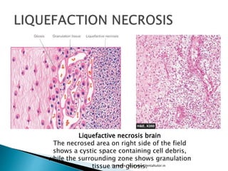 Liquefaction Necrosis Brain liquefaction-necrosis-brain