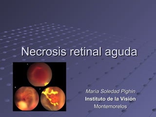 Necrosis retinal agudaNecrosis retinal aguda
María Soledad PighinMaría Soledad Pighin
Instituto de la VisiónInstituto de la Visión
MontemorelosMontemorelos
 