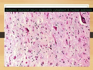 Ischemic neuronal injury:acidophilic cytoplasm & nuclear pyknosis
 