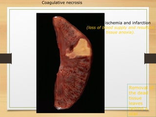 Kidney: ischemia and infarction
(loss of blood supply and resultant
tissue anoxia).
Coagulative necrosis
Removal of
the dead
tissue
leaves
behind a
scar
 
