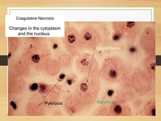 Coagulative Necrosis
 
Changes in the cytoplasm
and the nucleus  
Karyolysis Pyknosis
Karyorrhexis
 