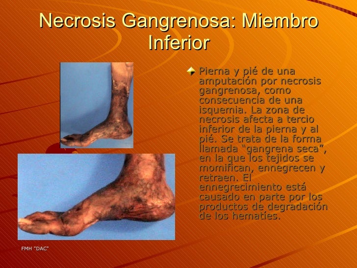 Necrosi sss