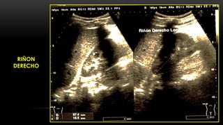 CASO CLINICO Necrosis Tubular Aguda PDF caso-clinico-necrosis-tubular-aguda-pdf