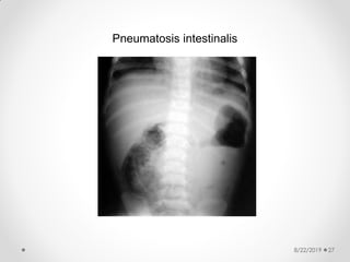 8/22/2019 27
Pneumatosis intestinalis
 