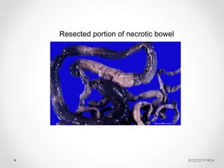 8/22/2019 34
Resected portion of necrotic bowel
 