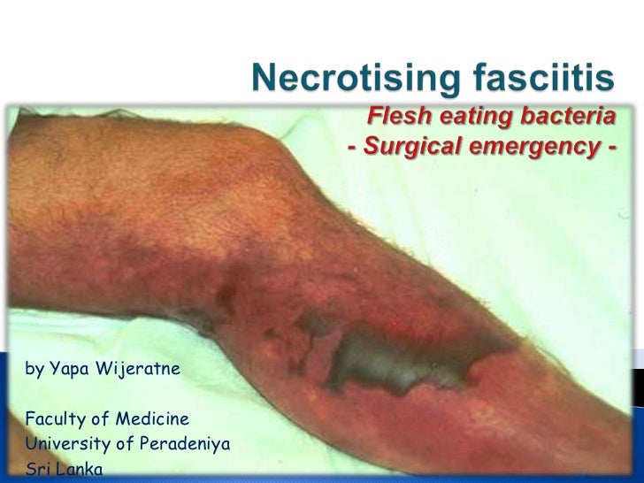 necrotizing facsiitis Necrotizing fasciitis is a dangerous infection of soft-tissue that starts in the subcutaneous tissue (just below the skin) and spreads along the flat layers of fibrous tissue that separate different layers of tissue (fascial planes) it most commonly occurs in the arms, legs and abdominal wall. necrotizing facsiitis Necrotizing fasciitis is a dangerous infection of soft-tissue that starts in the subcutaneous tissue (just below the skin) and spreads along the flat layers of fibrous tissue that separate different layers of tissue (fascial planes) it most commonly occurs in the arms, legs and abdominal wall.