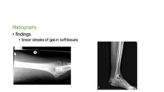 Radiographs
• findings
• linear streaks of gasin softtissues
 