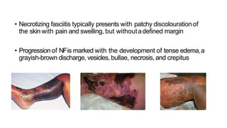 • Necrotizing fasciitis typically presents with patchy discolourationof
the skin with pain and swelling, but withoutadefined margin
• Progression of NFis marked with the development of tense edema,a
grayish-brown discharge, vesicles, bullae, necrosis, and crepitus
 