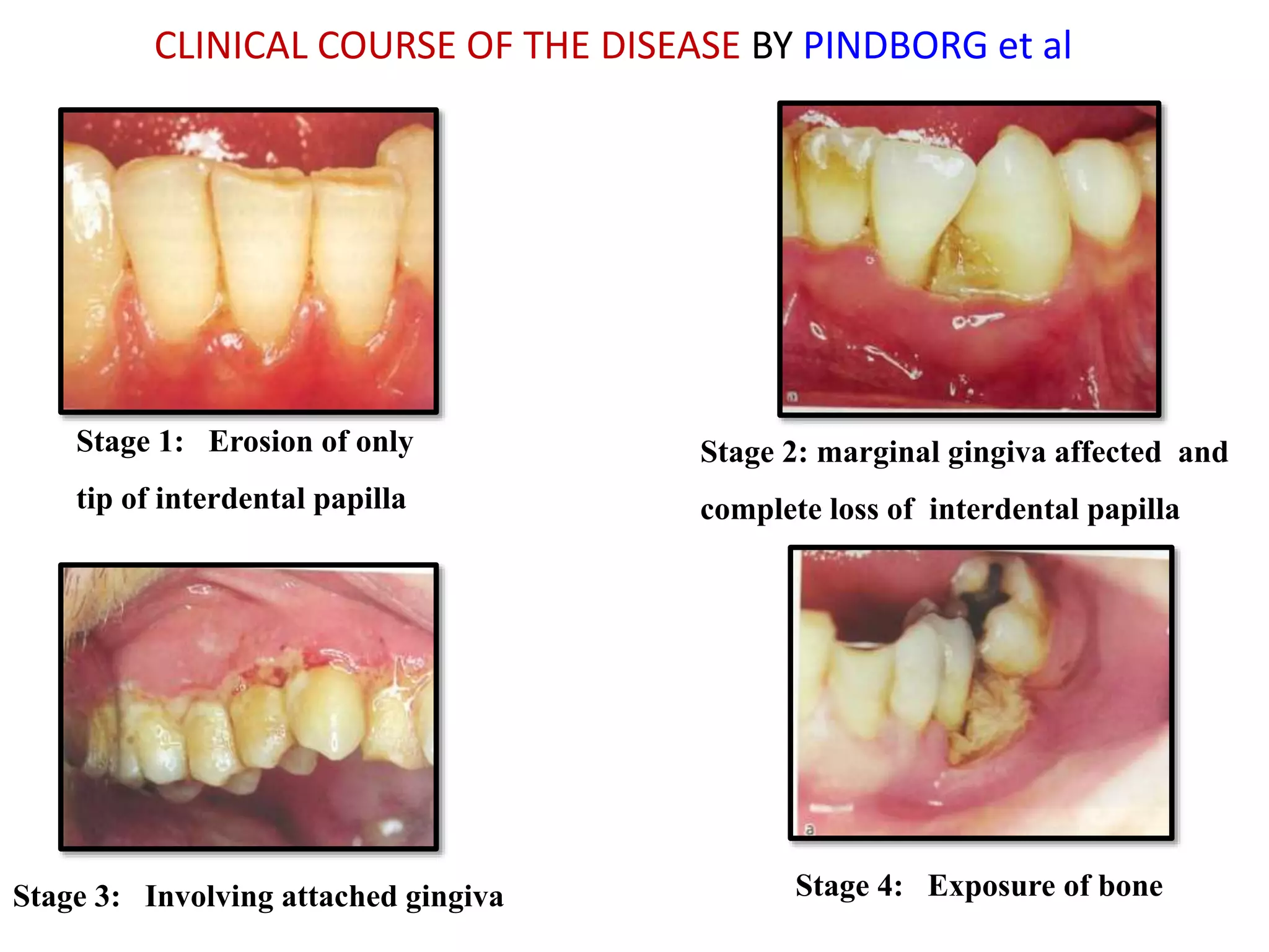 Necrotising periodontal diseases | PPTX