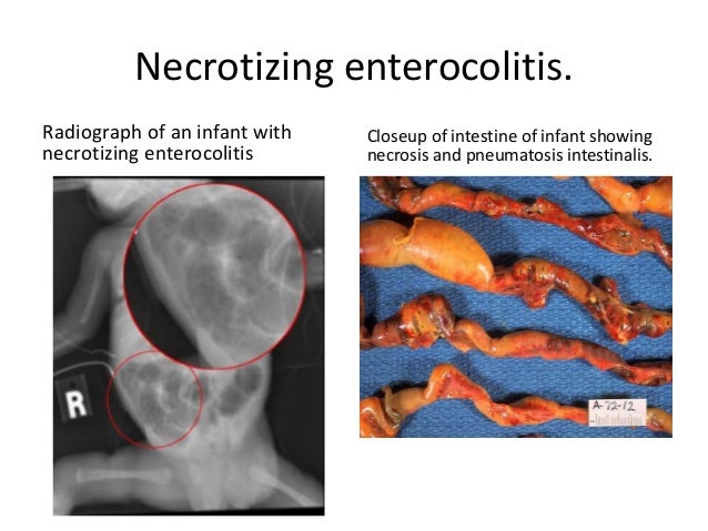 Necrotizing Fasciitis: Background, Pathophysiology, Etiology