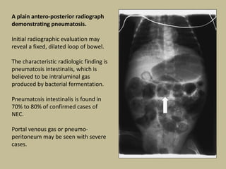 A plain antero-posterior radiograph
demonstrating pneumatosis.
Initial radiographic evaluation may
reveal a fixed, dilated loop of bowel.
The characteristic radiologic finding is
pneumatosis intestinalis, which is
believed to be intraluminal gas
produced by bacterial fermentation.
Pneumatosis intestinalis is found in
70% to 80% of confirmed cases of
NEC.
Portal venous gas or pneumo-
peritoneum may be seen with severe
cases.
 