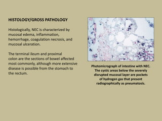 Photomicrograph of intestine with NEC.
The cystic areas below the severely
disrupted mucosal layer are pockets
of hydrogen gas that present
radiographically as pneumatosis.
HISTOLOGY/GROSS PATHOLOGY
Histologically, NEC is characterized by
mucosal edema, inflammation,
hemorrhage, coagulation necrosis, and
mucosal ulceration.
The terminal ileum and proximal
colon are the sections of bowel affected
most commonly, although more extensive
disease is possible from the stomach to
the rectum.
 