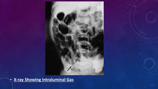 • X-ray Showing Intraluminal Gas
 