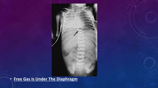 • Free Gas Is Under The Diaphragm
 