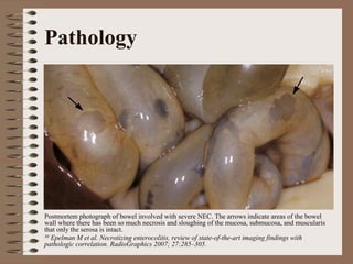 Pathology




Postmortem photograph of bowel involved with severe NEC. The arrows indicate areas of the bowel
wall where there has been so much necrosis and sloughing of the mucosa, submucosa, and muscularis
that only the serosa is intact.
30 Epelman M et al. Necrotizing enterocolitis, review of state-of-the-art imaging findings with
pathologic correlation. RadioGraphics 2007; 27:285–305.
 