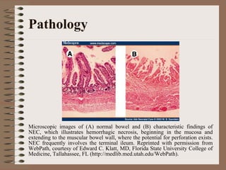 Pathology




Microscopic images of (A) normal bowel and (B) characteristic findings of
NEC, which illustrates hemorrhagic necrosis, beginning in the mucosa and
extending to the muscular bowel wall, where the potential for perforation exists.
NEC frequently involves the terminal ileum. Reprinted with permission from
WebPath, courtesy of Edward C. Klatt, MD, Florida State University College of
Medicine, Tallahassee, FL (http://medlib.med.utah.edu/WebPath).
 