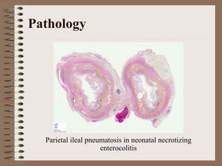 Pathology




  Parietal ileal pneumatosis in neonatal necrotizing
                     enterocolitis
 
