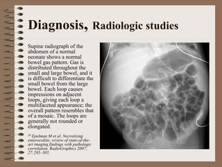 Diagnosis, Radiologic studies
Supine radiograph of the
abdomen of a normal
neonate shows a normal
bowel gas pattern. Gas is
distributed throughout the
small and large bowel, and it
is difficult to differentiate the
small bowel from the large
bowel. Each loop causes
impressions on adjacent
loops, giving each loop a
multifaceted appearance; the
overall pattern resembles that
of a mosaic. The loops are
generally not rounded or
elongated.
30Epelman M et al. Necrotizing
enterocolitis, review of state-of-the-
art imaging findings with pathologic
correlation. RadioGraphics 2007;
27:285–305.
 