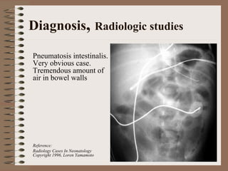 Diagnosis, Radiologic studies

Pneumatosis intestinalis.
Very obvious case.
Tremendous amount of
air in bowel walls




Reference:
Radiology Cases In Neonatology
Copyright 1996, Loren Yamamoto
 