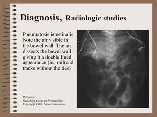 Diagnosis, Radiologic studies
Pneumatosis intestinalis.
Note the air visible in
the bowel wall. The air
dissects the bowel wall
giving it a double lined
appearance (ie., railroad
tracks without the ties)




Reference:
Radiology Cases In Neonatology
Copyright 1996, Loren Yamamoto
 