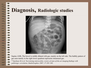 Diagnosis, Radiologic studies




Supine AXR, The bowel is mildly dilated with gas, mainly on the left side. The bubbly pattern of
gas seen mainly in the right lower quadrant represents intramural gas.
30Epelman M et al. Necrotizing enterocolitis, review of state-of-the-art imaging findings with
pathologic correlation. RadioGraphics 2007; 27:285–305.
 