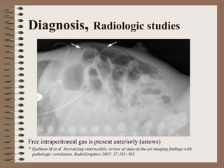 Diagnosis, Radiologic studies




Free intraperitoneal gas is present anteriorly (arrows)
30   Epelman M et al. Necrotizing enterocolitis, review of state-of-the-art imaging findings with
     pathologic correlation. RadioGraphics 2007; 27:285–305.
 