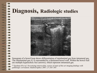 Diagnosis, Radiologic studies




Sonogram of a bowel loop shows differentiation of intraluminal gas from intramural gas.
The intraluminal gas (L) is surrounded by a thickened bowel wall. Within the bowel wall
are multiple hyperechoic foci (arrows), which represent intramural gas.
30Epelman M et al. Necrotizing enterocolitis, review of state-of-the-art imaging findings with
pathologic correlation. RadioGraphics 2007; 27:285–305.
 