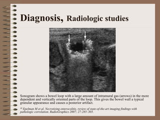Diagnosis, Radiologic studies




Sonogram shows a bowel loop with a large amount of intramural gas (arrows) in the more
dependent and vertically oriented parts of the loop. This gives the bowel wall a typical
granular appearance and causes a posterior artifact.
30Epelman M et al. Necrotizing enterocolitis, review of state-of-the-art imaging findings with
pathologic correlation. RadioGraphics 2007; 27:285–305.
 