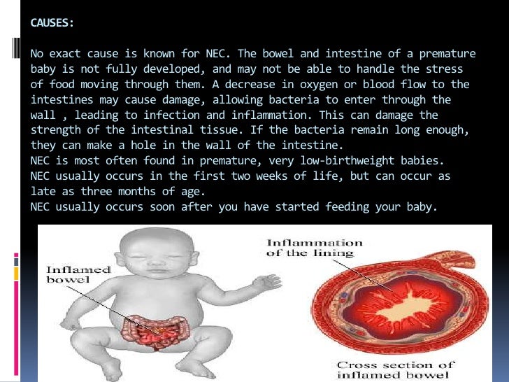 Necrotizing enterocolitis (nec) presentation {abdul fatah}