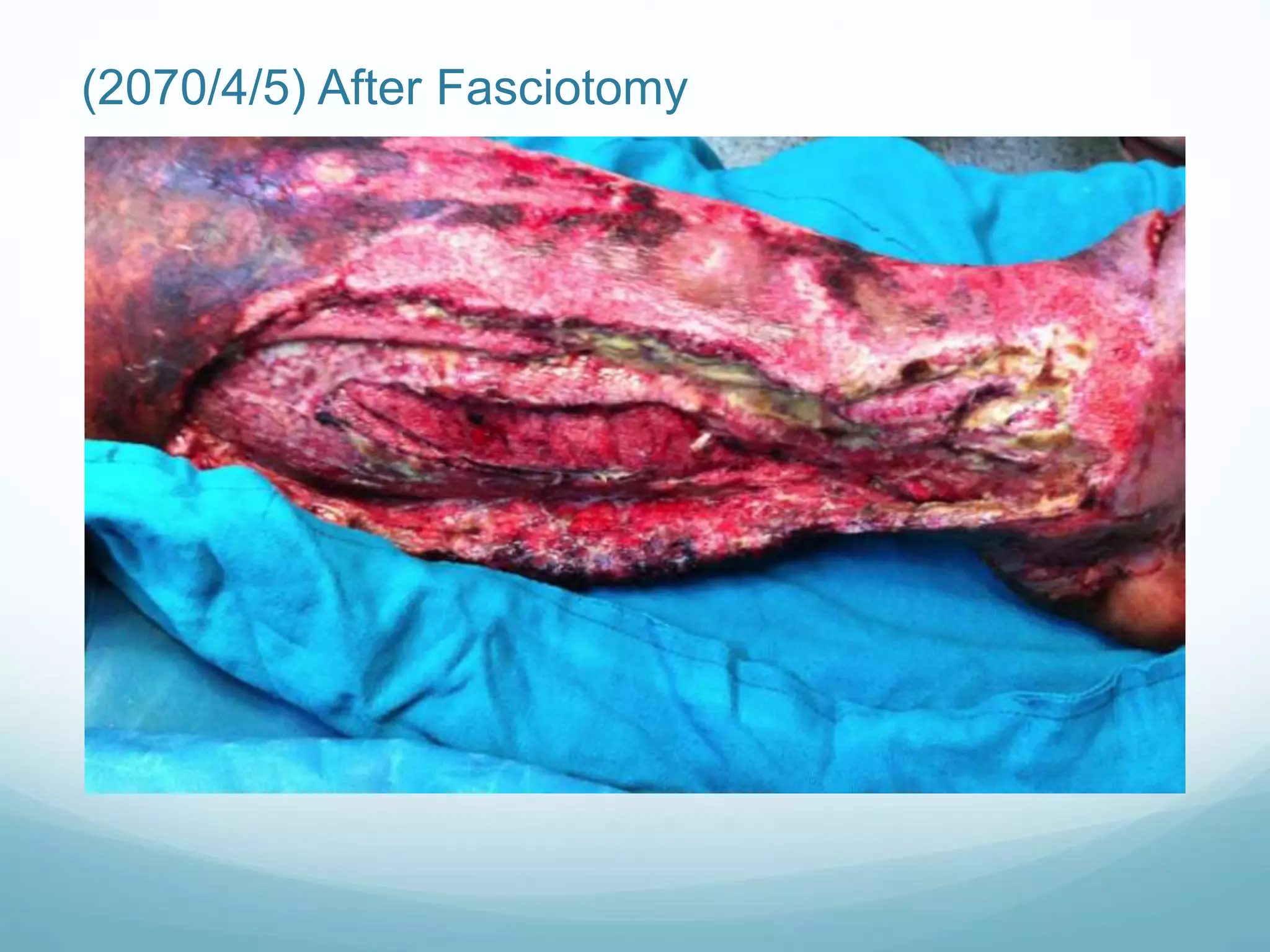 (2070/4/5) After Fasciotomy
 