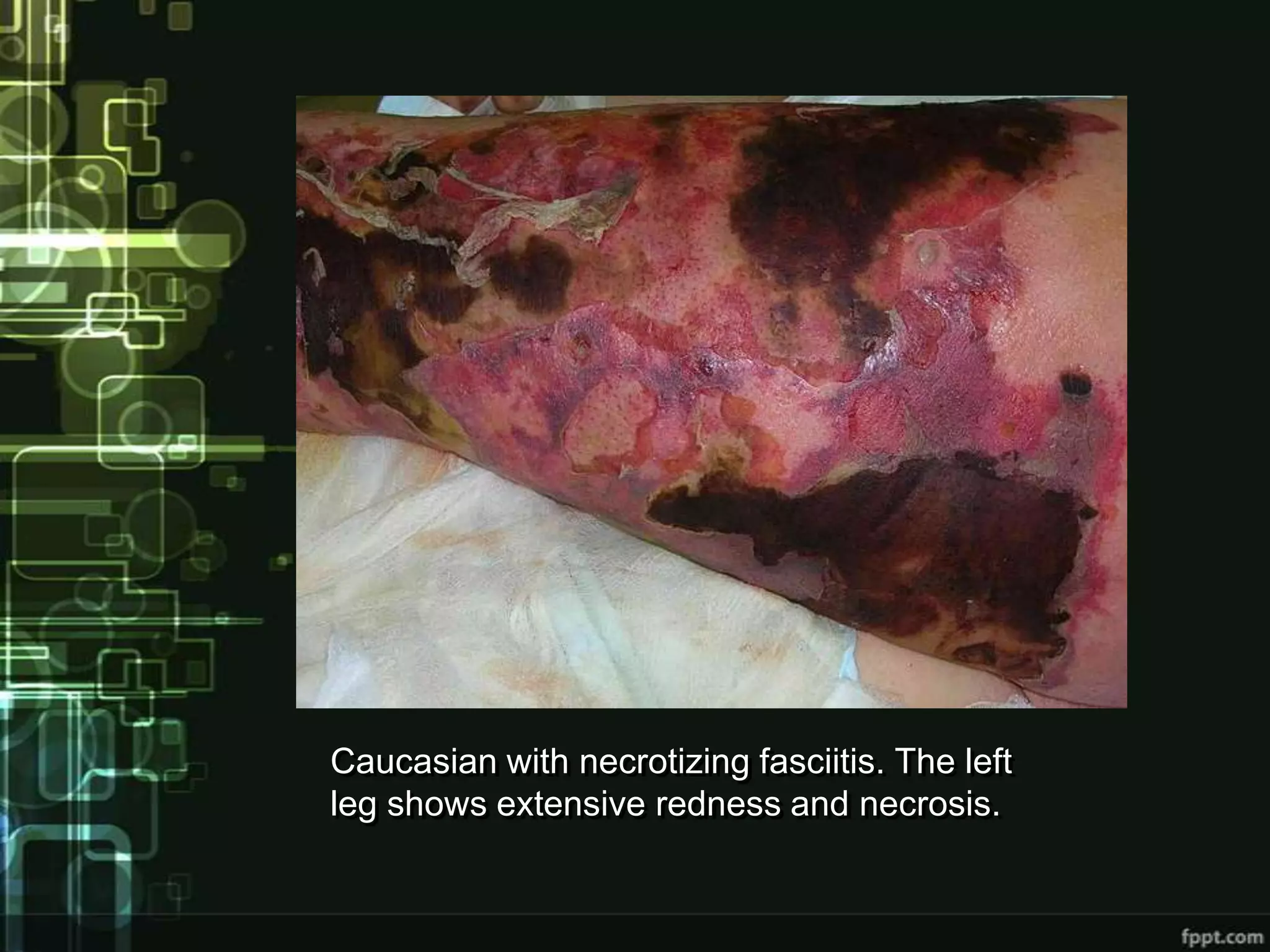 Caucasian with necrotizing fasciitis. The left
leg shows extensive redness and necrosis.
 