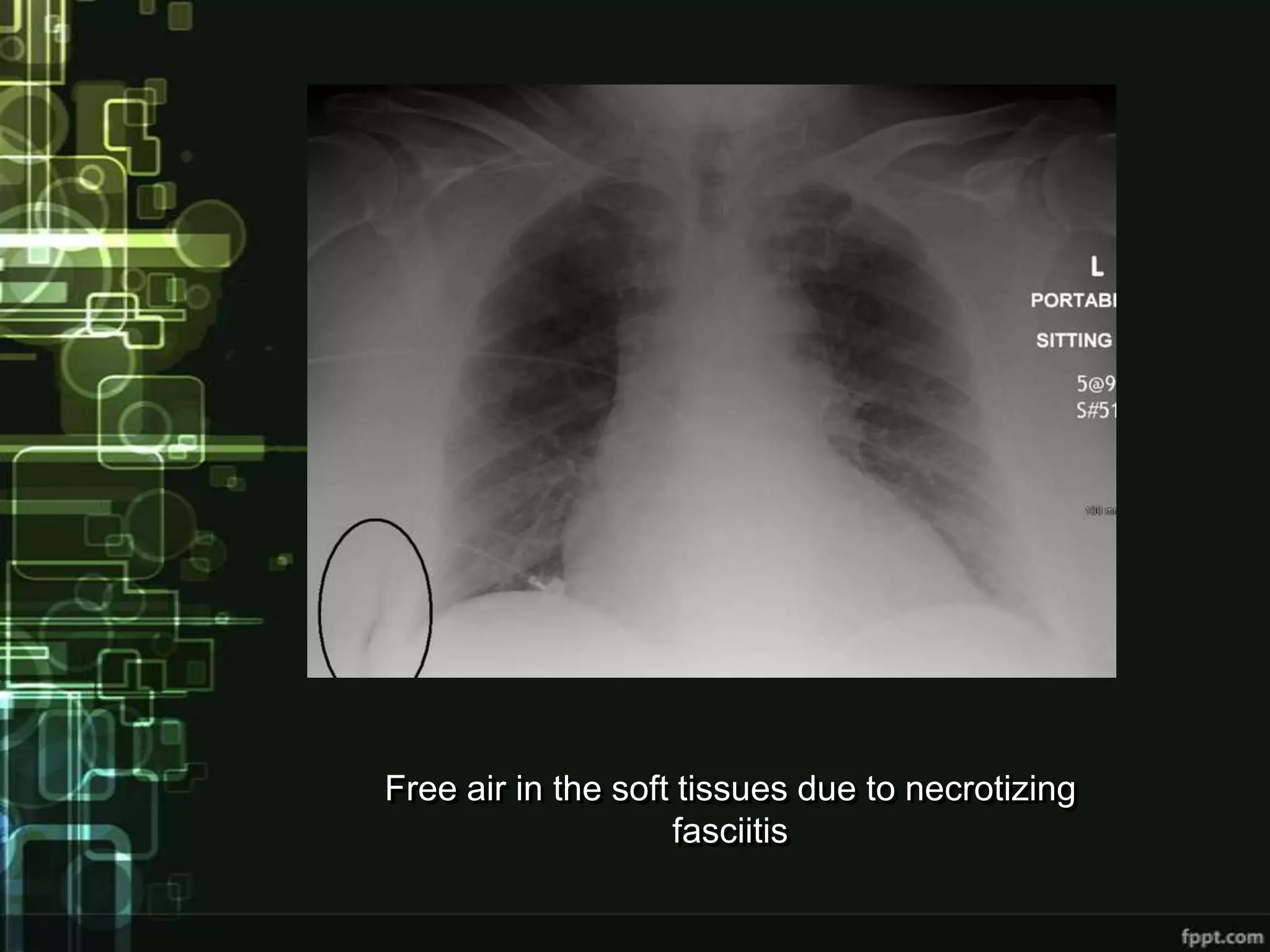 Free air in the soft tissues due to necrotizing
                    fasciitis
 