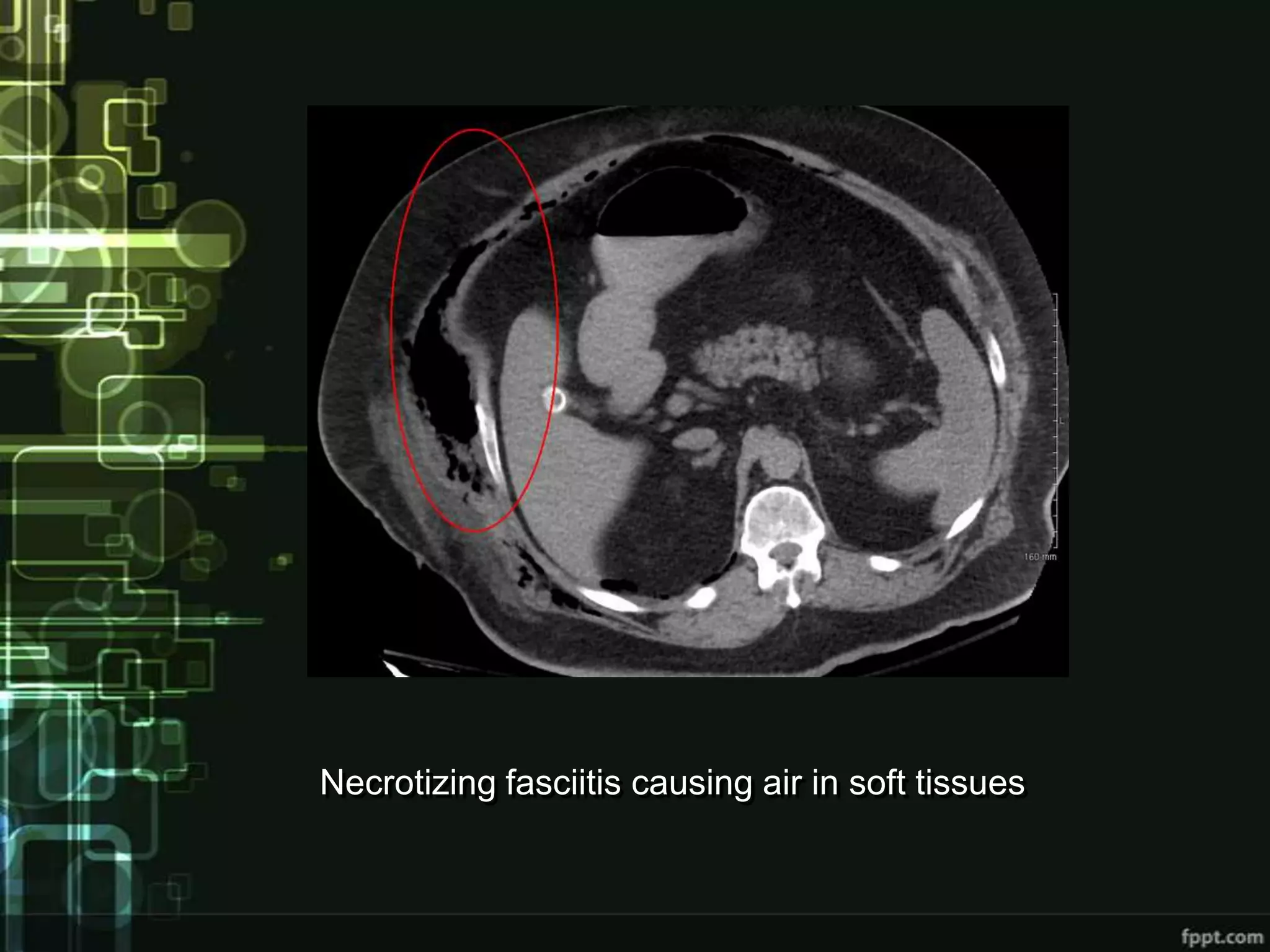 Necrotizing fasciitis causing air in soft tissues
 