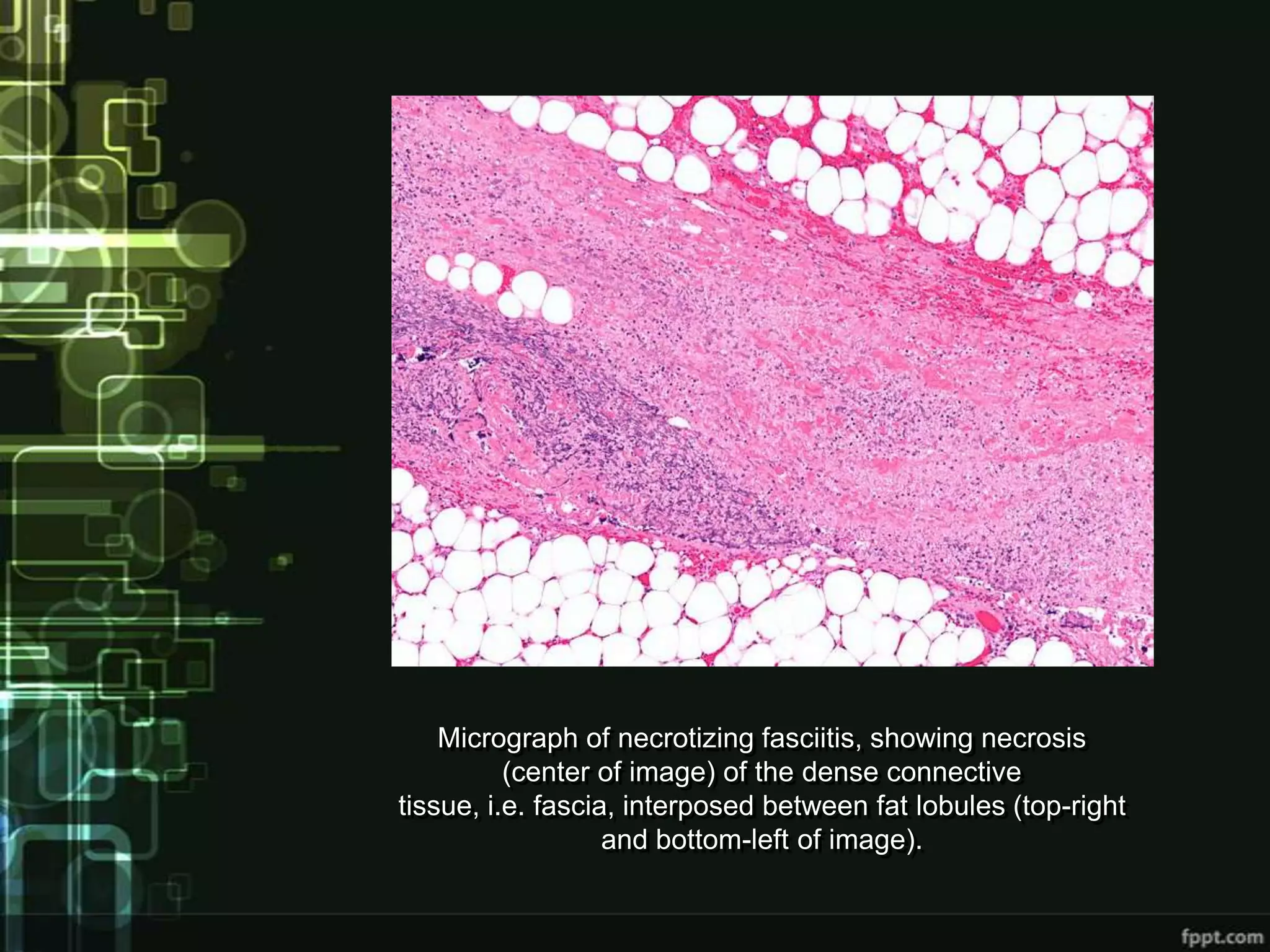 Micrograph of necrotizing fasciitis, showing necrosis
          (center of image) of the dense connective
tissue, i.e. fascia, interposed between fat lobules (top-right
                   and bottom-left of image).
 