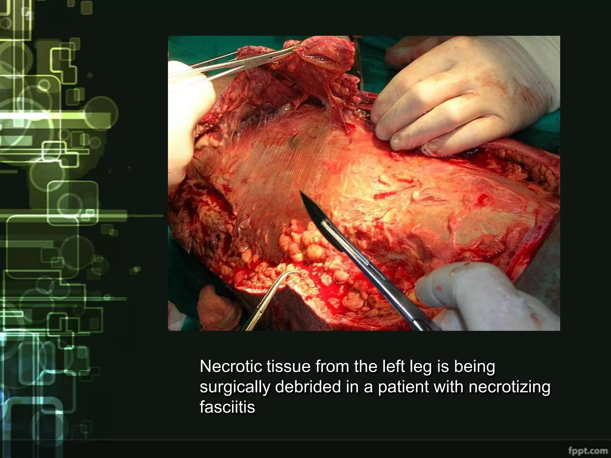 Necrotic tissue from the left leg is being
surgically debrided in a patient with necrotizing
fasciitis
 