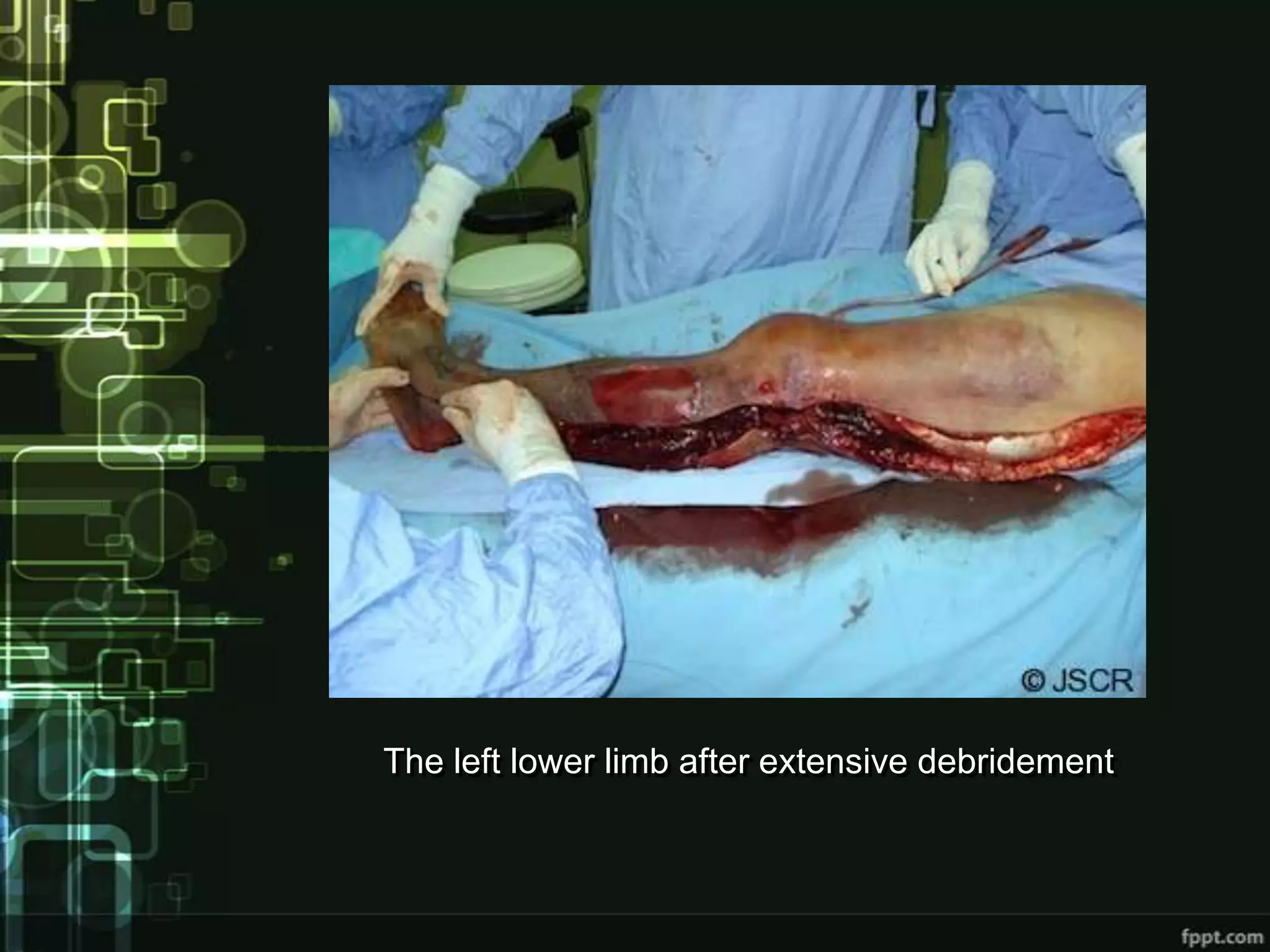 The left lower limb after extensive debridement
 