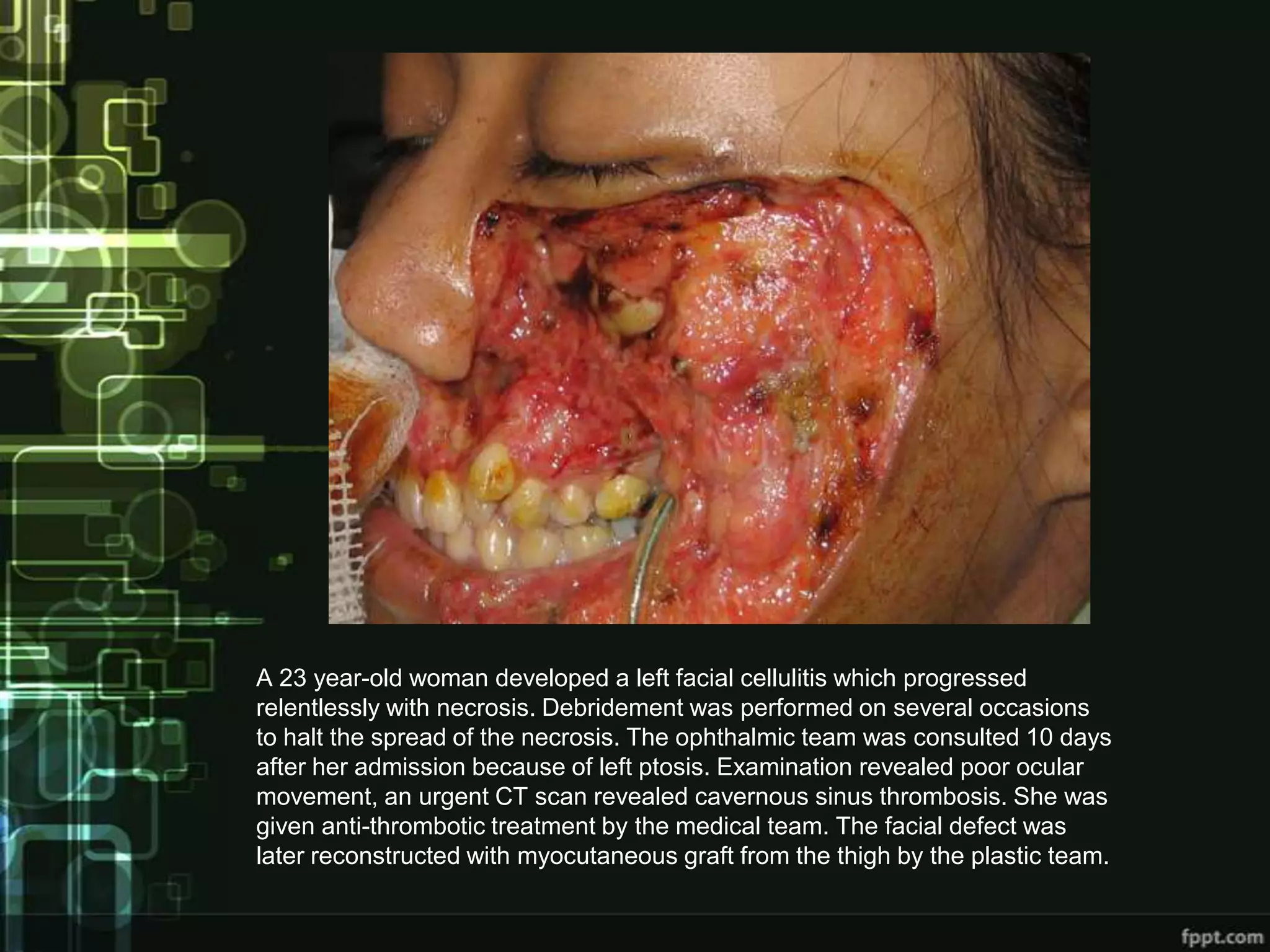 A 23 year-old woman developed a left facial cellulitis which progressed
relentlessly with necrosis. Debridement was performed on several occasions
to halt the spread of the necrosis. The ophthalmic team was consulted 10 days
after her admission because of left ptosis. Examination revealed poor ocular
movement, an urgent CT scan revealed cavernous sinus thrombosis. She was
given anti-thrombotic treatment by the medical team. The facial defect was
later reconstructed with myocutaneous graft from the thigh by the plastic team.
 