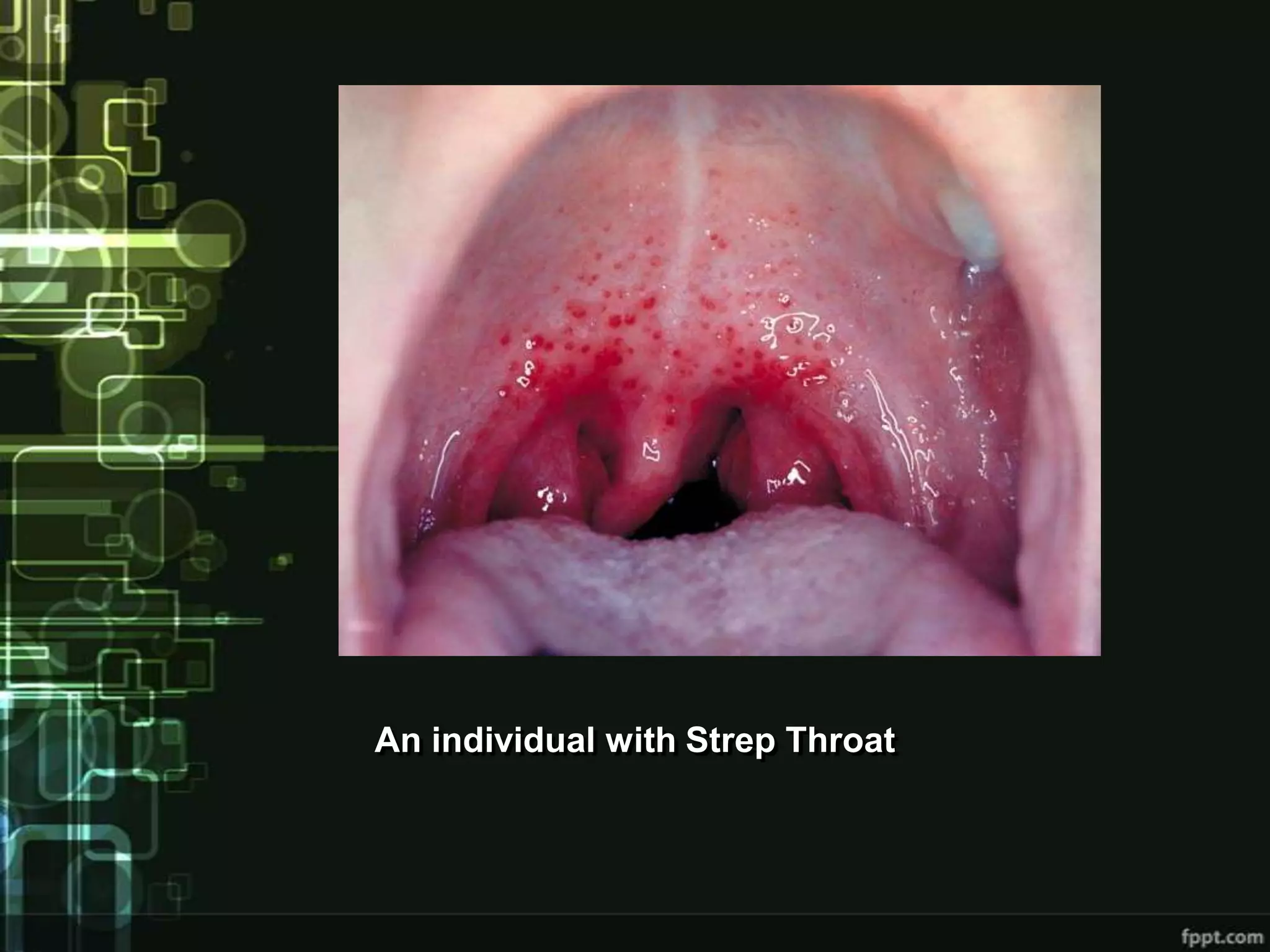 An individual with Strep Throat
 