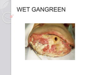 WET GANGREEN
 