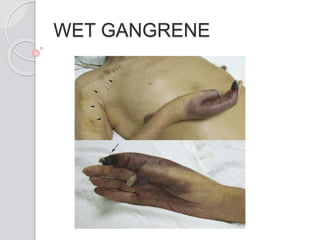 WET GANGRENE
 