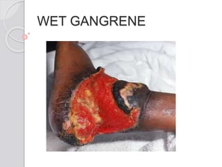 WET GANGRENE
 