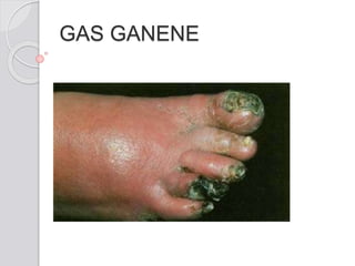 GAS GANENE
 