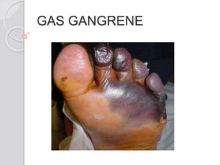 GAS GANGRENE
 