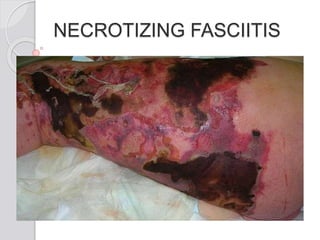 NECROTIZING FASCIITIS
 